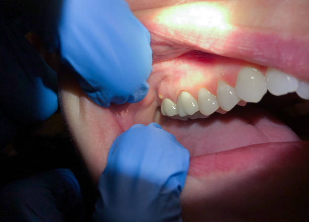 Best Cracked Tooth Emergency Dentist  in San Ramon, CA